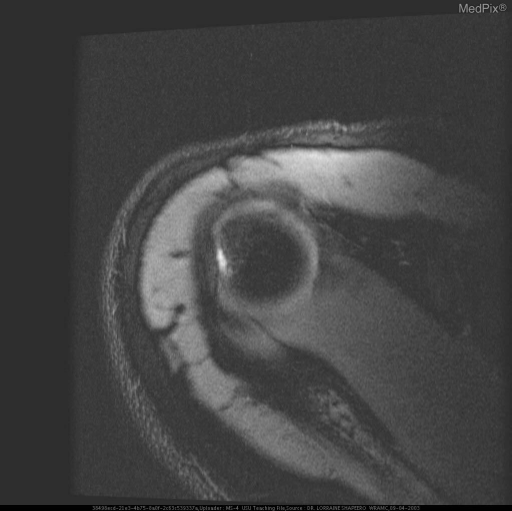 Hill-Sachs and Bankart on MRI