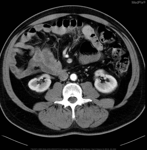CT scan of lower abdomen showing dilated thick-walled appendix with periappendiceal fat stranding - CT diagnosis of acute appendicitis