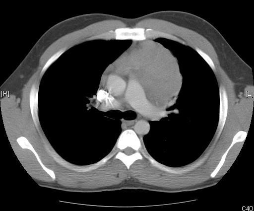 CT chest showing large anterior mediastinal soft tissue mass - thymoma/lymphoma differential