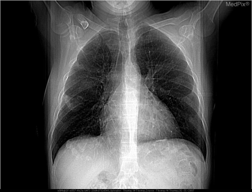 Asbestos-related calcified pleural plaques - CXR