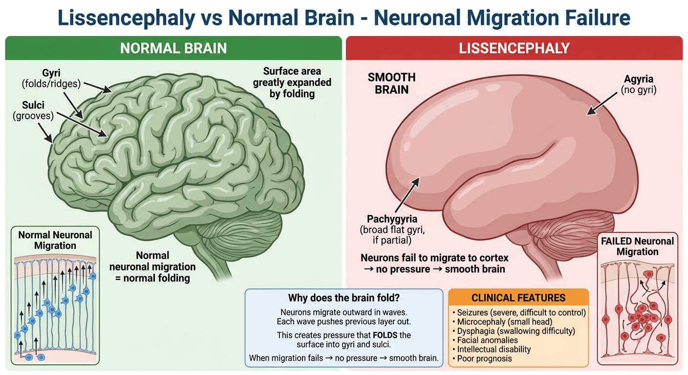 Lissencephaly vs Normal Brain