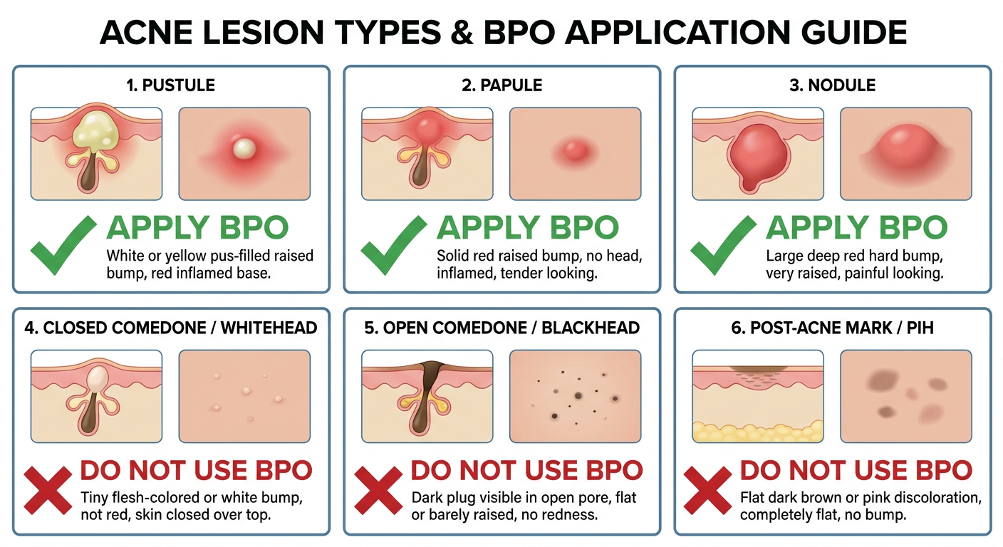 BPO Guide - Types of Acne