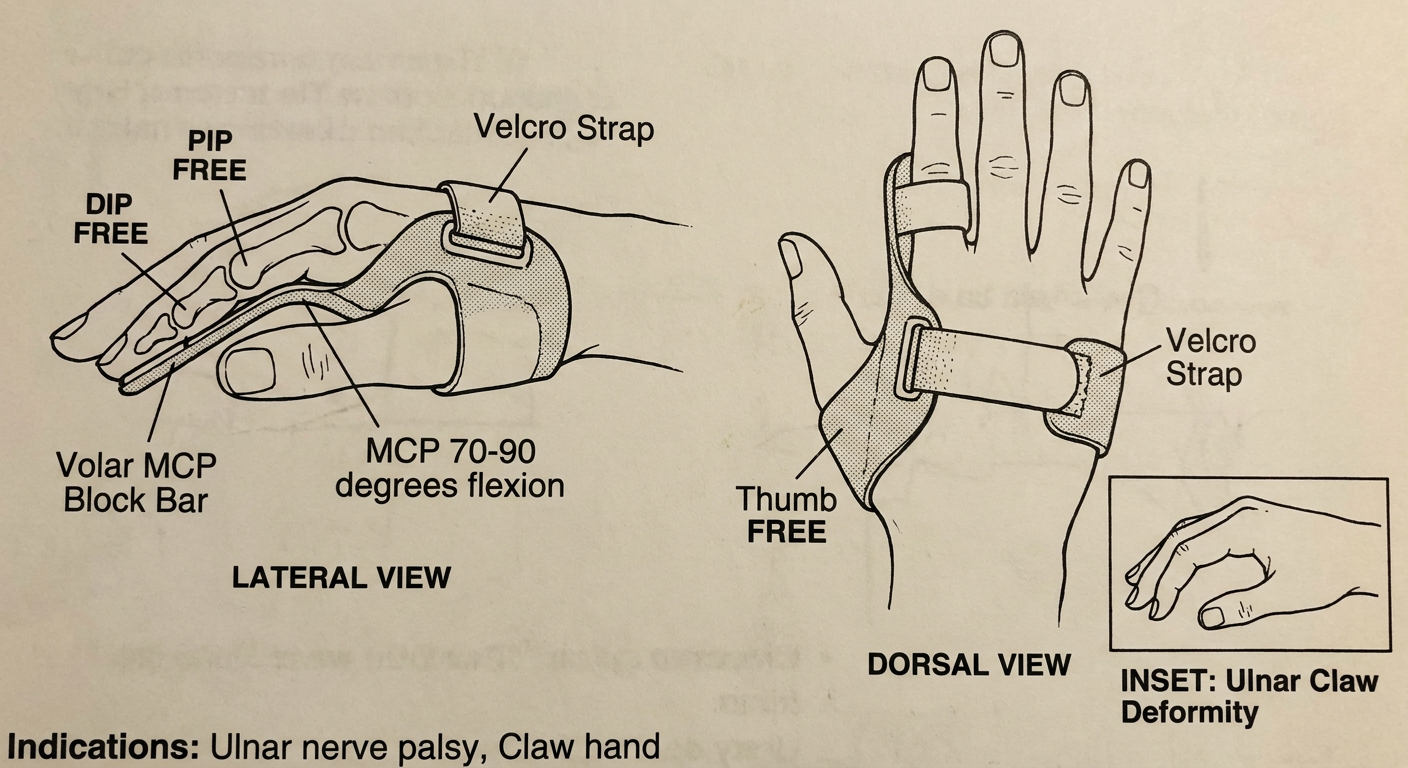MCP Blocking Orthosis (Anti-Claw Splint) - Drawable Diagram