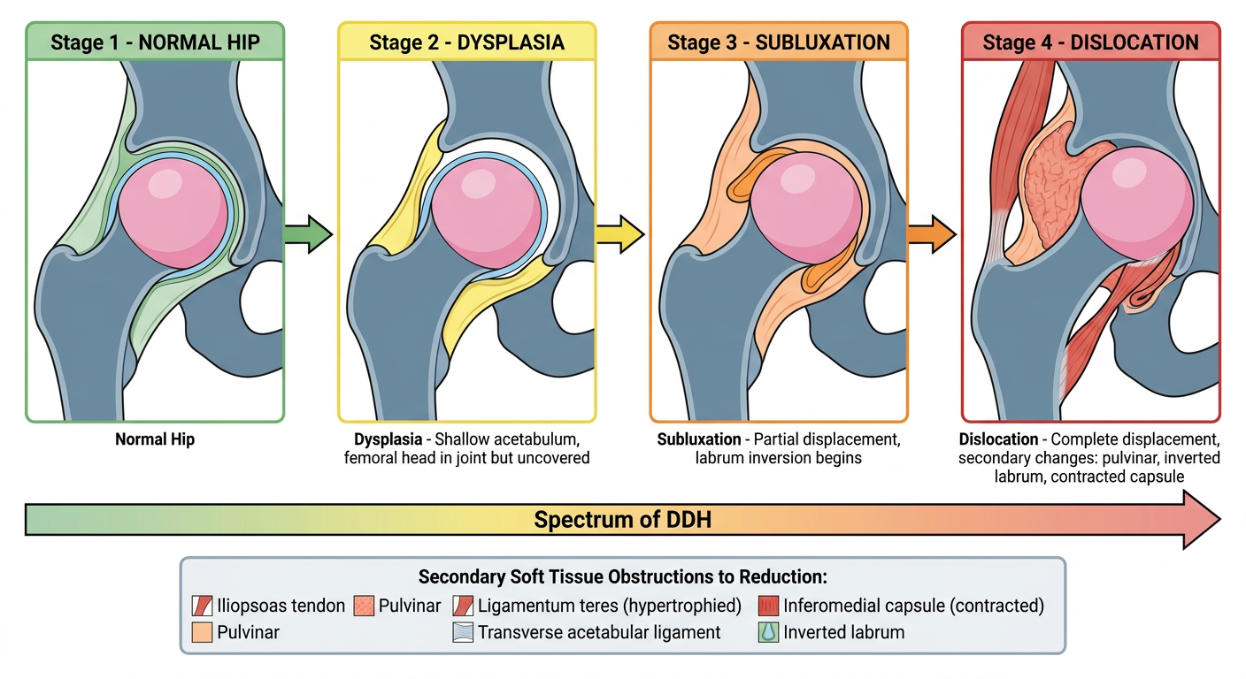 DDH Pathology Stages - Visual Summary